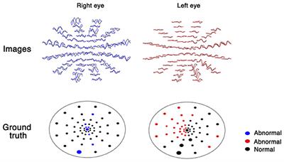 Using Deep Learning for the Classification of Images Generated by Multifocal Visual Evoked Potential